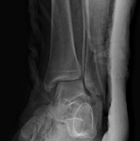 Ankle Weber C Syndesmotic Injury